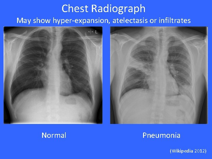 Chest Radiograph May show hyper-expansion, atelectasis or infiltrates Normal Pneumonia (Wikipedia 2012) 
