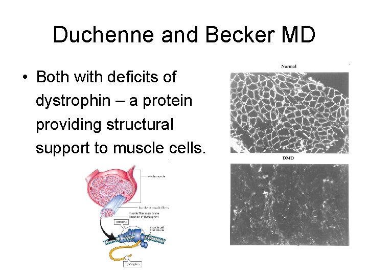 Duchenne and Becker MD • Both with deficits of dystrophin – a protein providing