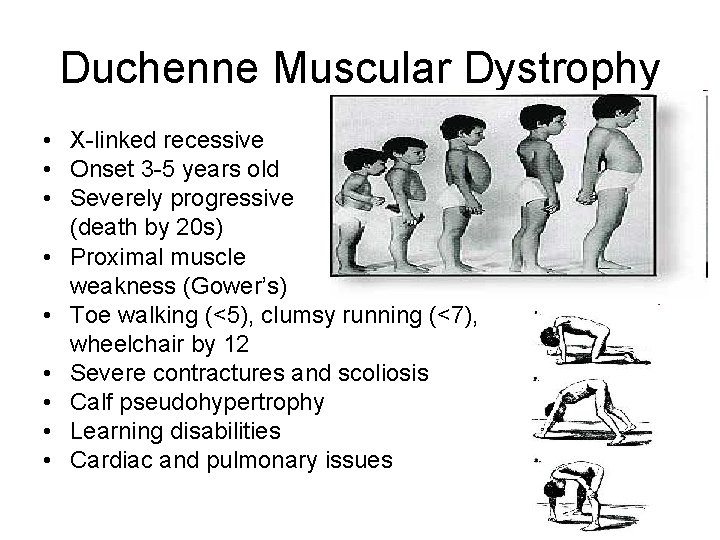 Duchenne Muscular Dystrophy • X-linked recessive • Onset 3 -5 years old • Severely