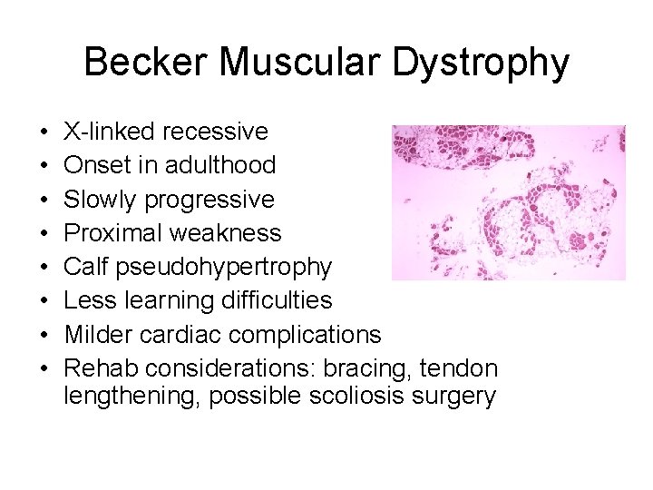 Becker Muscular Dystrophy • • X-linked recessive Onset in adulthood Slowly progressive Proximal weakness