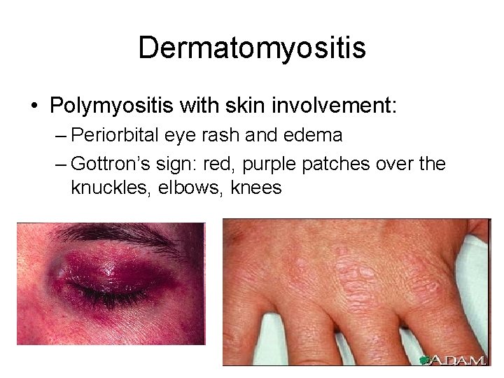 Dermatomyositis • Polymyositis with skin involvement: – Periorbital eye rash and edema – Gottron’s