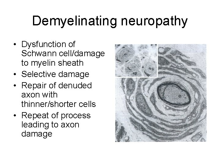 Demyelinating neuropathy • Dysfunction of Schwann cell/damage to myelin sheath • Selective damage •