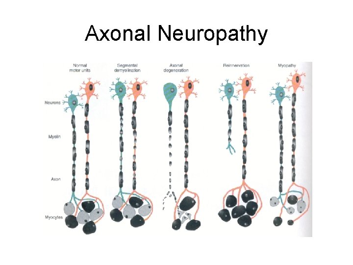 Axonal Neuropathy 