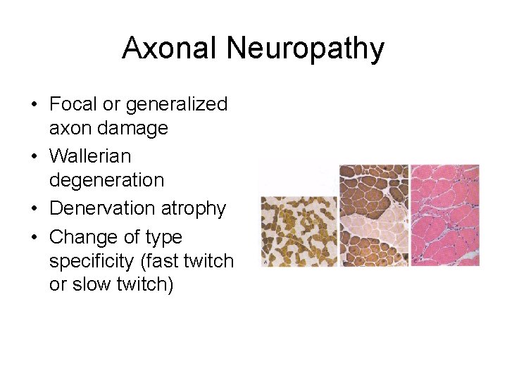 Axonal Neuropathy • Focal or generalized axon damage • Wallerian degeneration • Denervation atrophy