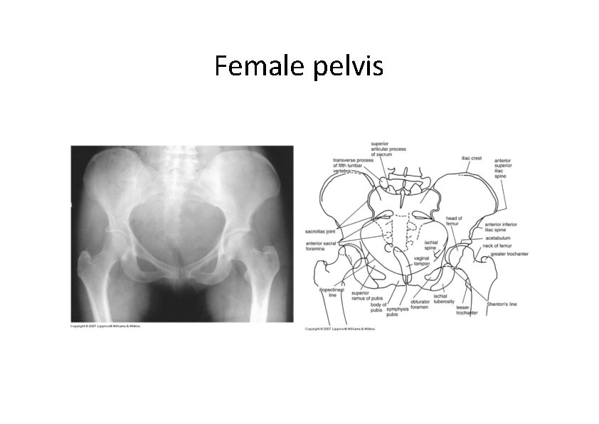 Female pelvis  Female pelvis