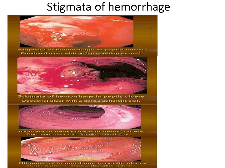 Stigmata of hemorrhage 