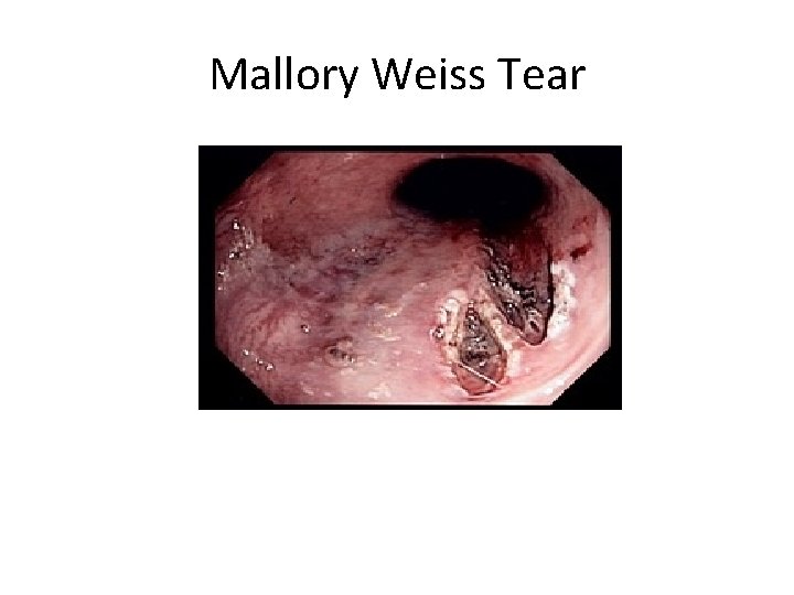 Mallory Weiss Tear 