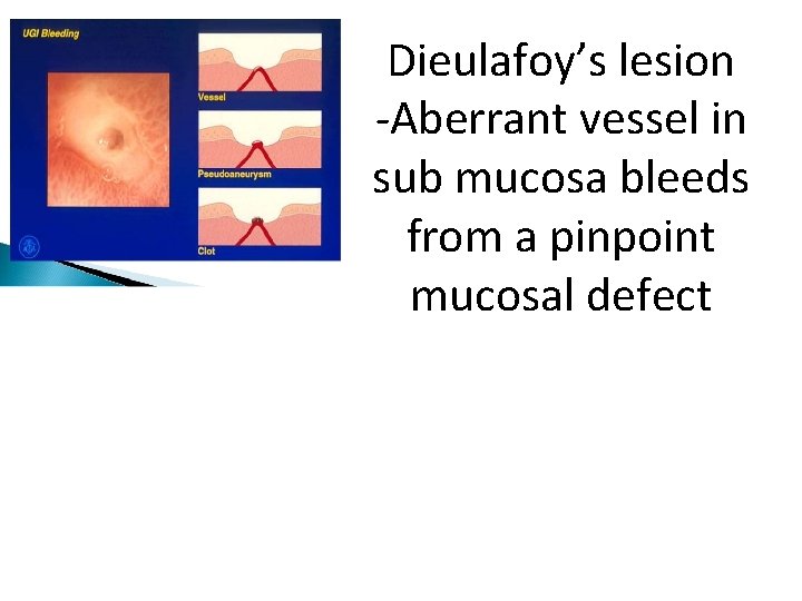 Dieulafoy’s lesion -Aberrant vessel in sub mucosa bleeds from a pinpoint mucosal defect 