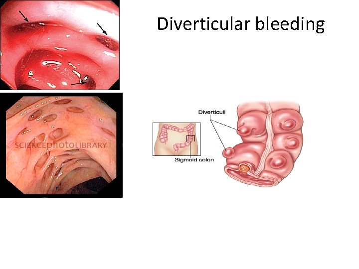 Diverticular bleeding 