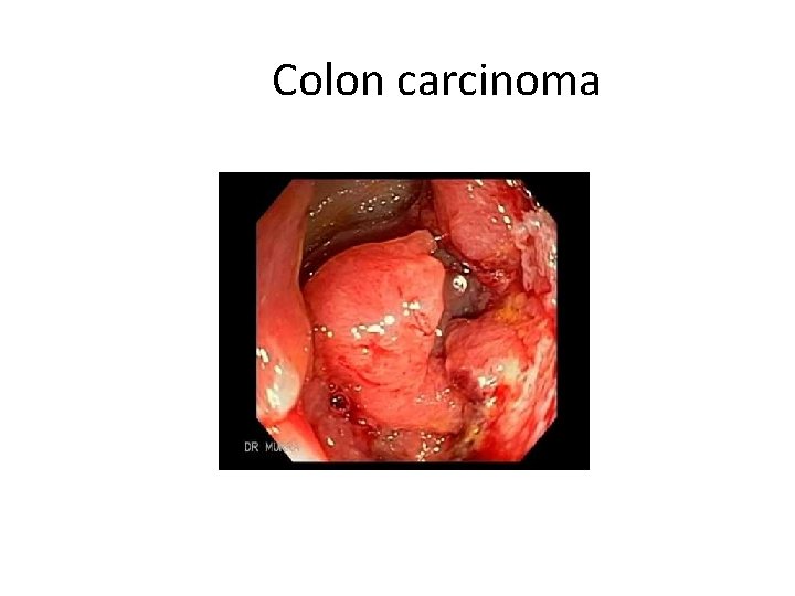 Colon carcinoma 