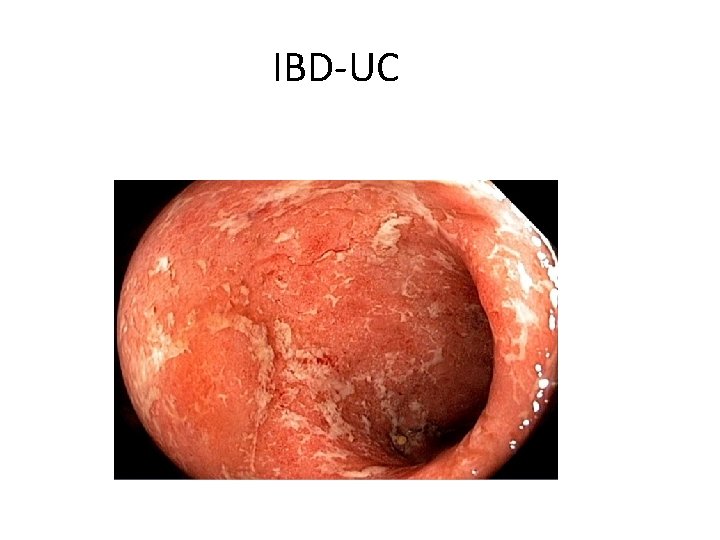 IBD-UC 