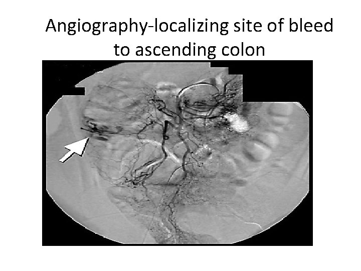 Angiography-localizing site of bleed to ascending colon 
