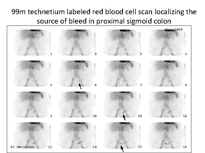 99 m technetium labeled red blood cell scan localizing the source of bleed in