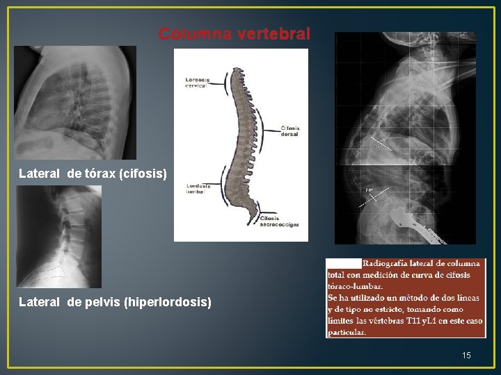 Columna vertebral Lateral de tórax (cifosis) Lateral de pelvis (hiperlordosis) 15 