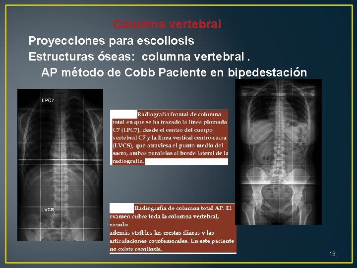 Columna vertebral Proyecciones para escoliosis Estructuras óseas: columna vertebral. AP método de Cobb Paciente