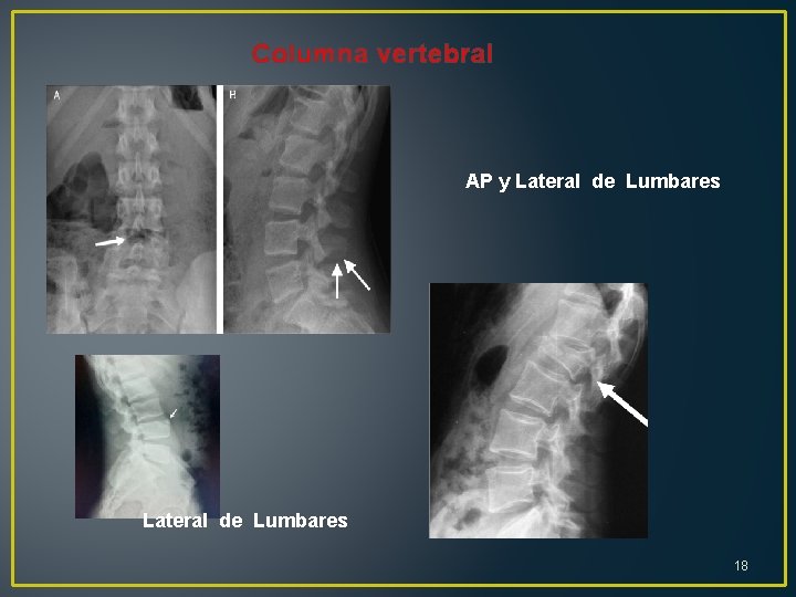 Columna vertebral AP y Lateral de Lumbares 18 