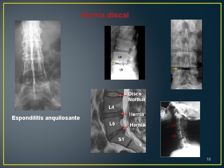 Hernia discal Espondilitis anquilosante 19 