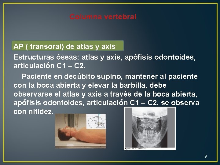 Columna vertebral AP ( transoral) de atlas y axis Estructuras óseas: atlas y axis,