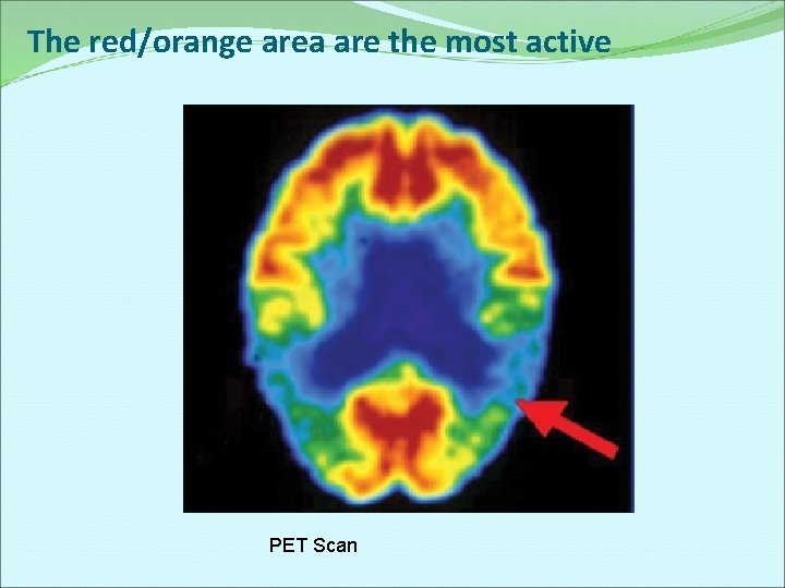 The red/orange area are the most active PET Scan 