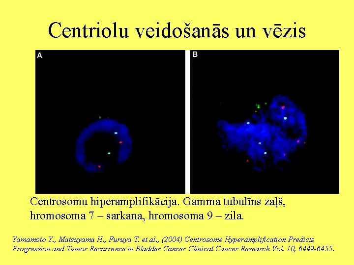Centriolu veidošanās un vēzis Centrosomu hiperamplifikācija. Gamma tubulīns zaļš, hromosoma 7 – sarkana, hromosoma