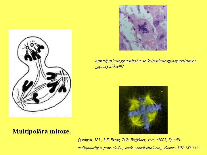 http: //pathology. catholic. ac. kr/pathology/aspnet/tumor _sp. aspx? kw=2 Multipolāra mitoze. Quintyne, N. J. ,