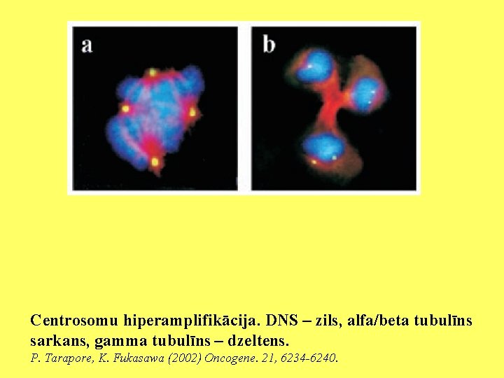 Centrosomu hiperamplifikācija. DNS – zils, alfa/beta tubulīns sarkans, gamma tubulīns – dzeltens. P. Tarapore,