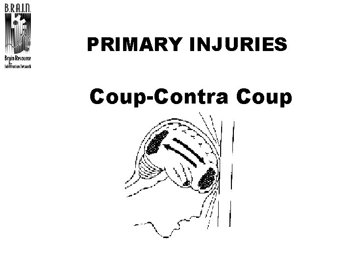 PRIMARY INJURIES Coup-Contra Coup 