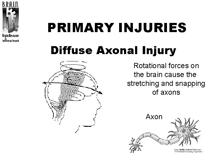 PRIMARY INJURIES Diffuse Axonal Injury Rotational forces on the brain cause the stretching and