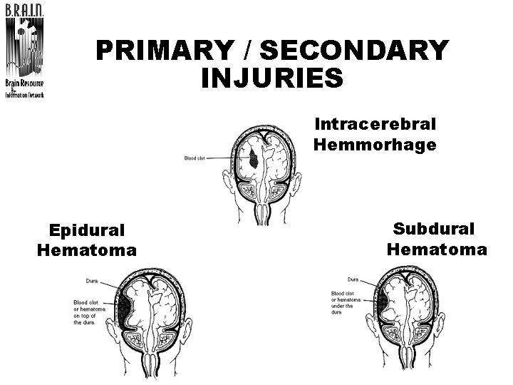 PRIMARY / SECONDARY INJURIES Intracerebral Hemmorhage Epidural Hematoma Subdural Hematoma 