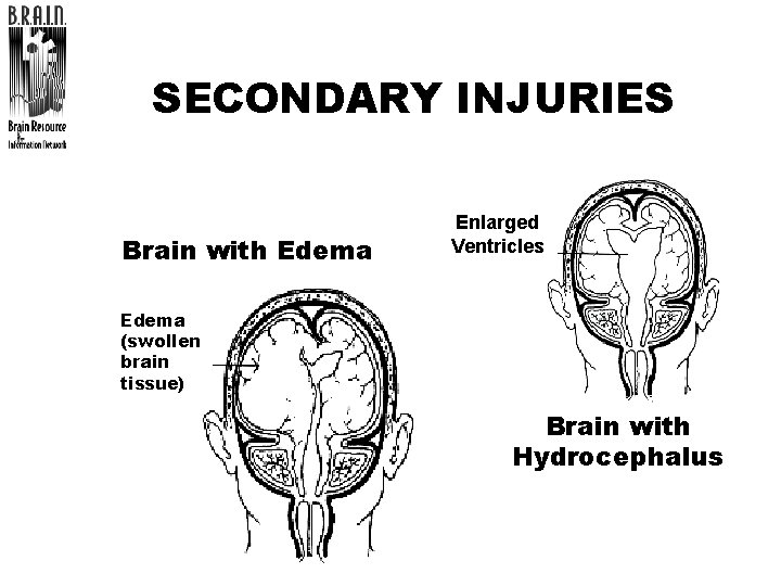 SECONDARY INJURIES Brain with Edema Enlarged Ventricles Edema (swollen brain tissue) Brain with Hydrocephalus