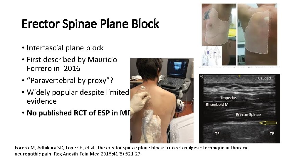 Erector Spinae Plane Block • Interfascial plane block • First described by Mauricio Forrero