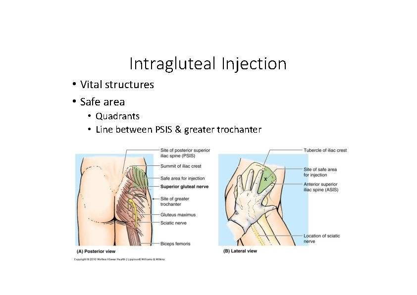 Intragluteal Injection • Vital structures • Safe area • Quadrants • Line between PSIS