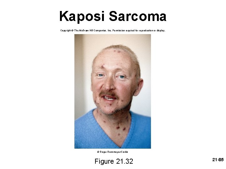 Kaposi Sarcoma Copyright © The Mc. Graw-Hill Companies, Inc. Permission required for reproduction or