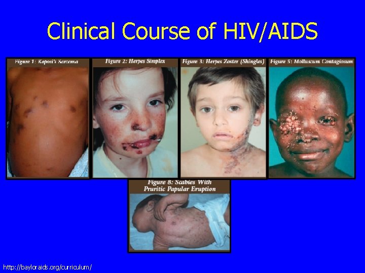 Clinical Course of HIV/AIDS http: //bayloraids. org/curriculum/ 