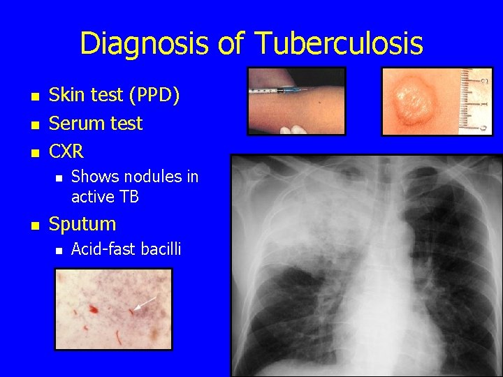 Diagnosis of Tuberculosis n n n Skin test (PPD) Serum test CXR n n