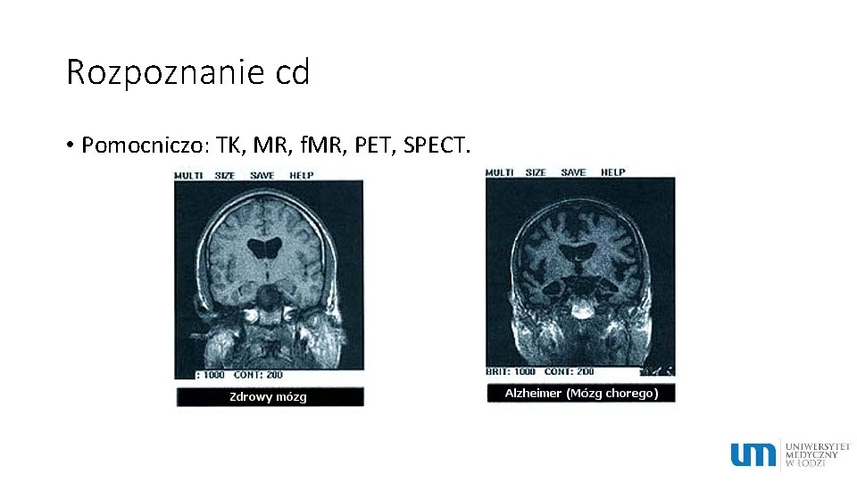 Rozpoznanie cd • Pomocniczo: TK, MR, f. MR, PET, SPECT. 