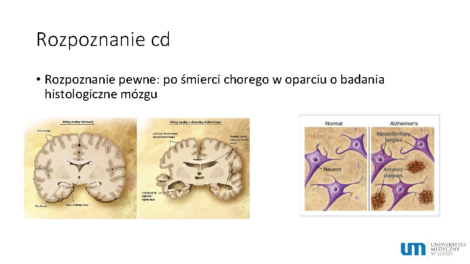 Rozpoznanie cd • Rozpoznanie pewne: po śmierci chorego w oparciu o badania histologiczne mózgu