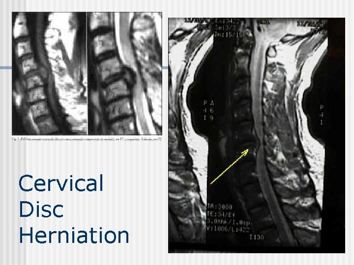 Cervical Disc Herniation 