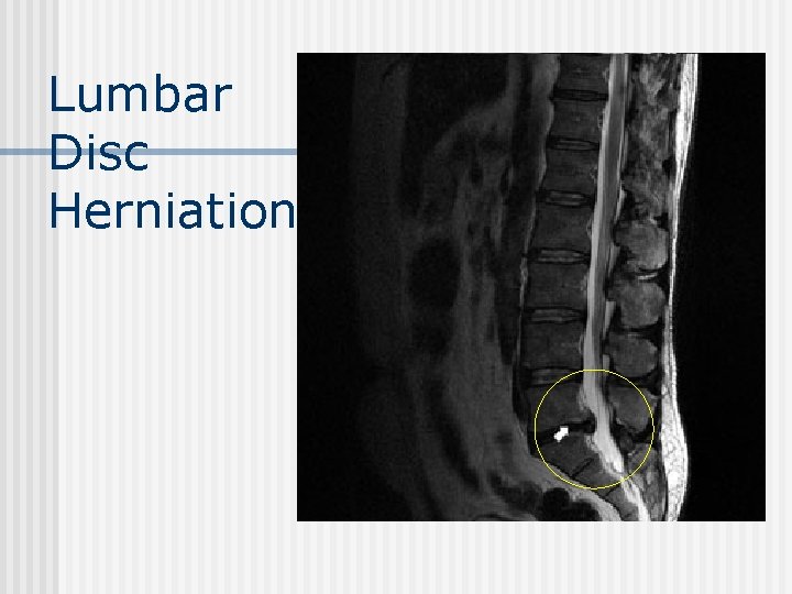 Lumbar Disc Herniation 