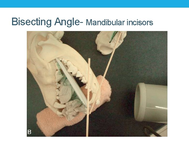 Bisecting Angle- Mandibular incisors 