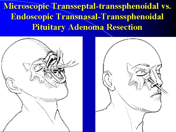 Microscopic Transseptal-transsphenoidal vs. Endoscopic Transnasal-Transsphenoidal Pituitary Adenoma Resection 