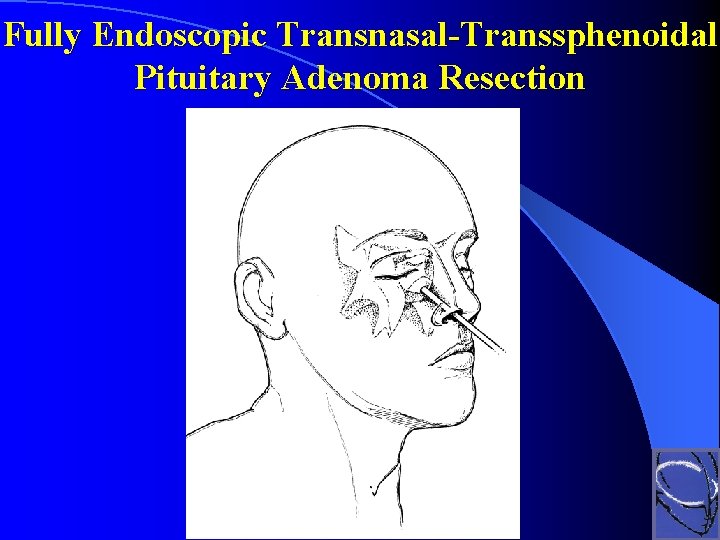 Fully Endoscopic Transnasal-Transsphenoidal Pituitary Adenoma Resection 