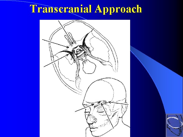 Transcranial Approach 