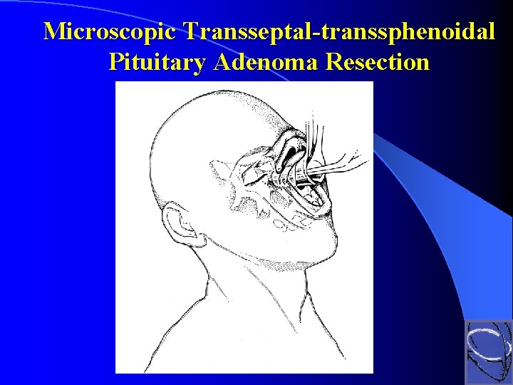 Microscopic Transseptal-transsphenoidal Pituitary Adenoma Resection 