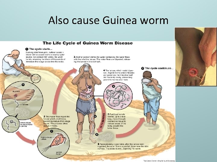 Also cause Guinea worm 