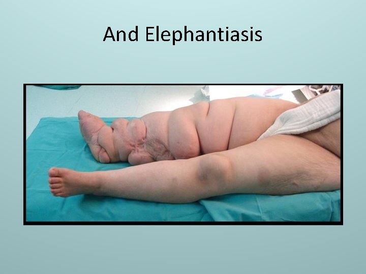 And Elephantiasis 