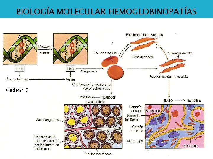 Anemia. MOLECULAR Falciforme, Drepanocítica, BIOLOGÍA HEMOGLOBINOPATÍAS en Forma de Hoz (sickle), o Hb. S