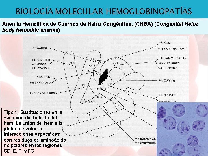 BIOLOGÍA MOLECULAR HEMOGLOBINOPATÍAS Anemia Hemolítica de Cuerpos de Heinz Congénitos, (CHBA) (Congenital Heinz body