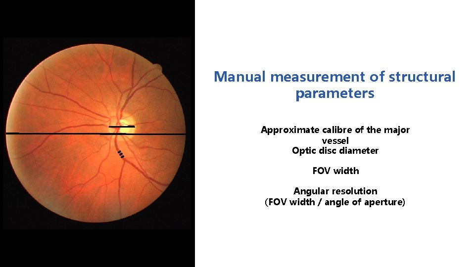 Manual measurement of structural parameters Approximate calibre of the major vessel Optic disc diameter