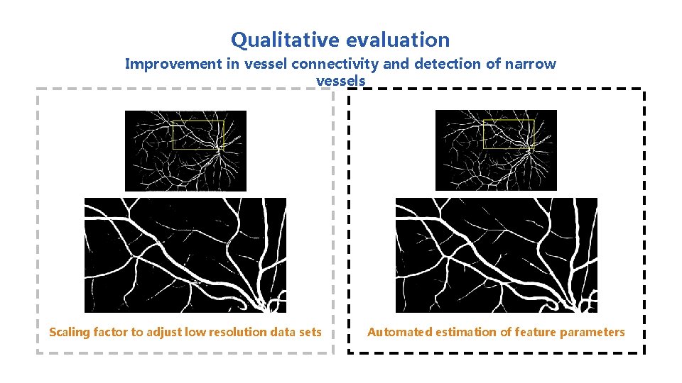 Qualitative evaluation Improvement in vessel connectivity and detection of narrow vessels Scaling factor to